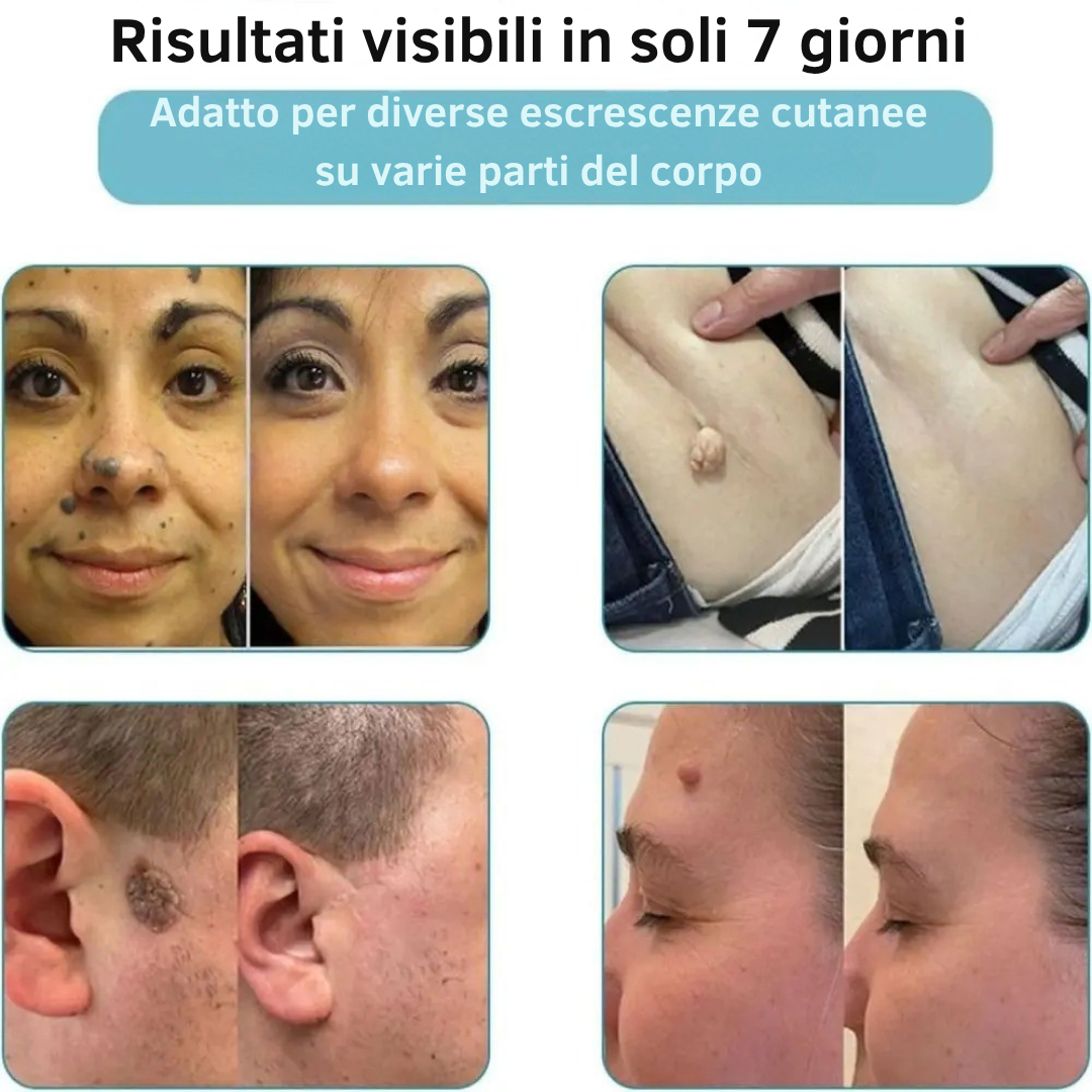 Aviralase ™ Pro - Macchie cutanee e verruche