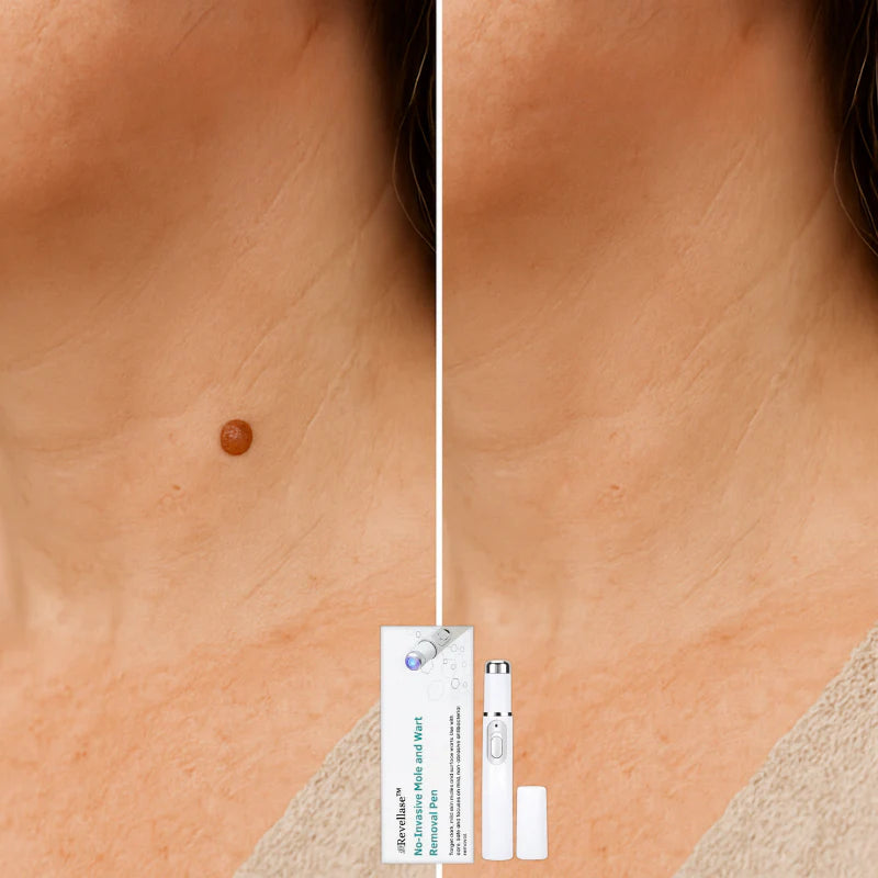 Aviralase ™ Pro - Macchie cutanee e verruche