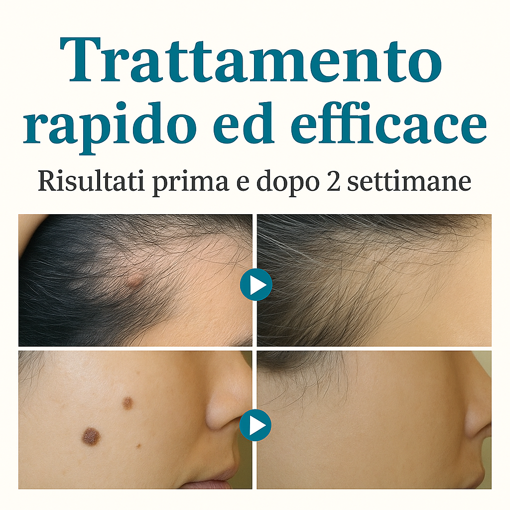 Aviralase ™ Pro - Macchie cutanee e verruche