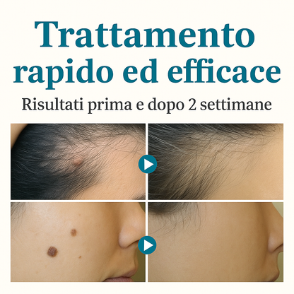 Aviralase ™ Pro - Macchie cutanee e verruche